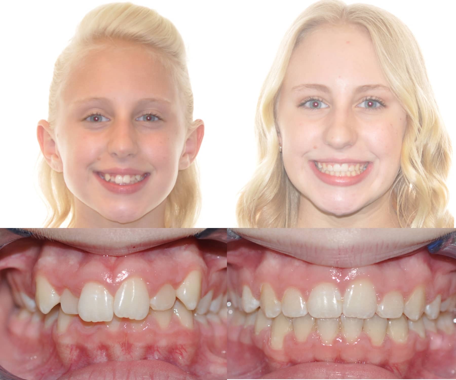 Bailey Orthodontics Bountiful Utah before and after