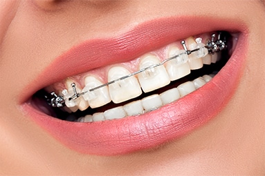 self-ligating braces Bailey Orthodontics Bountiful and Farmington UT
