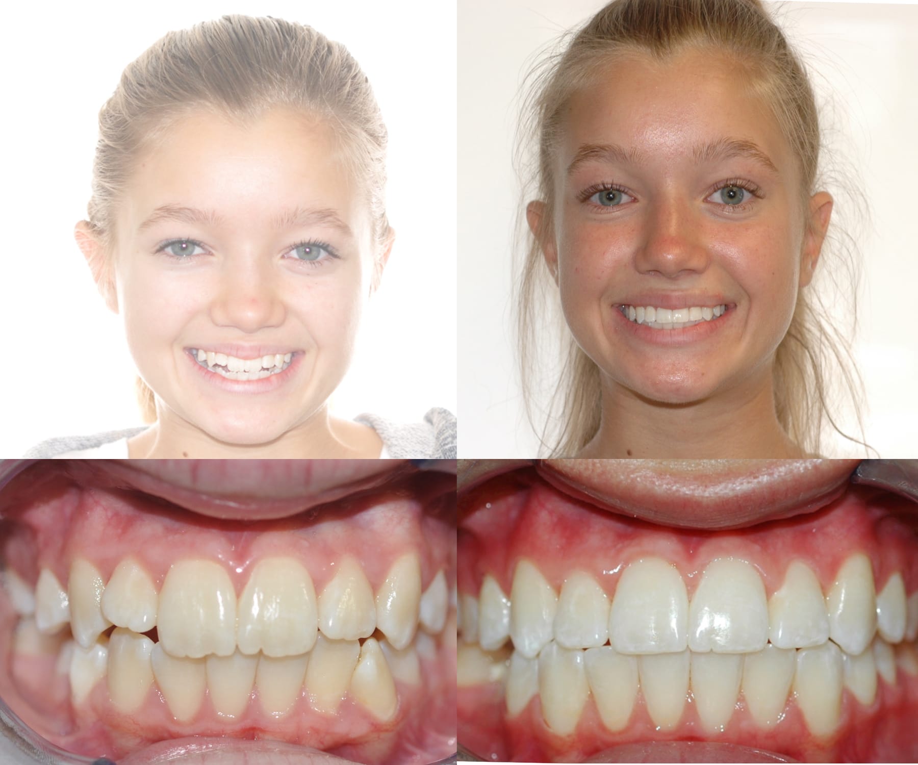 Bailey Orthodontics Farmington UT before and after