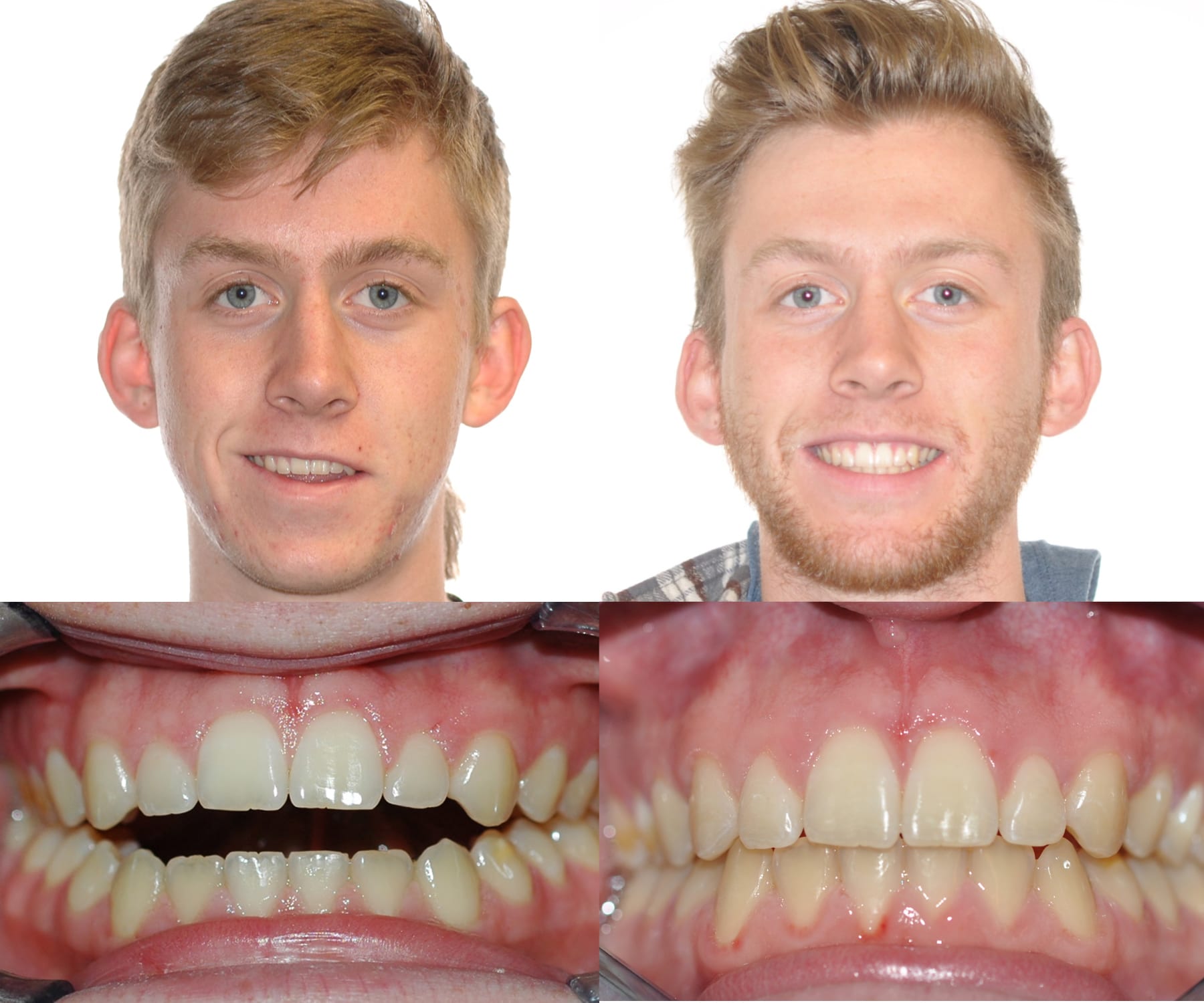 Bailey Orthodontics Farmington UT before and after