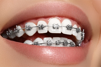 types of Braces Bailey Orthodontics Bountiful and Farmington