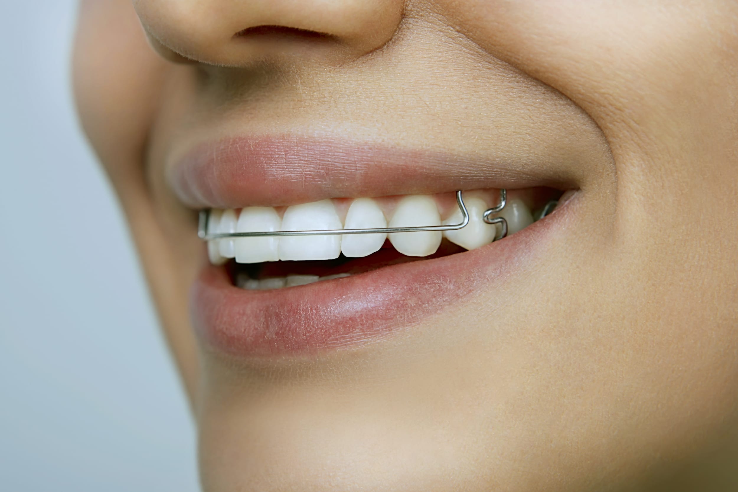Bailey Orthodontics-Farmington-UT retainers