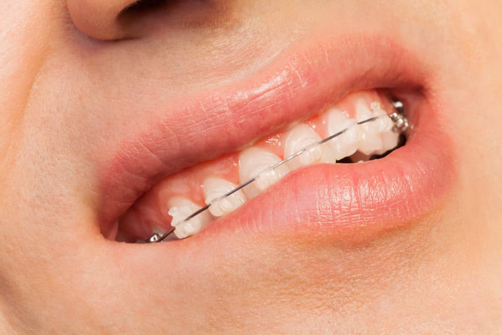 orthodontic issues at home