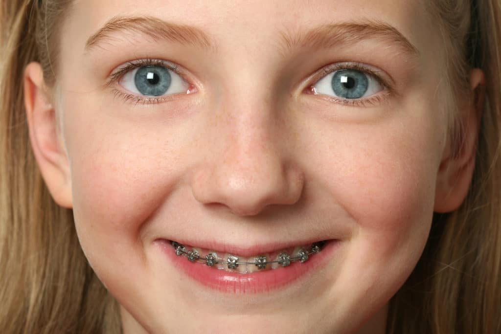 When Should You Start Orthodontic Treatment?