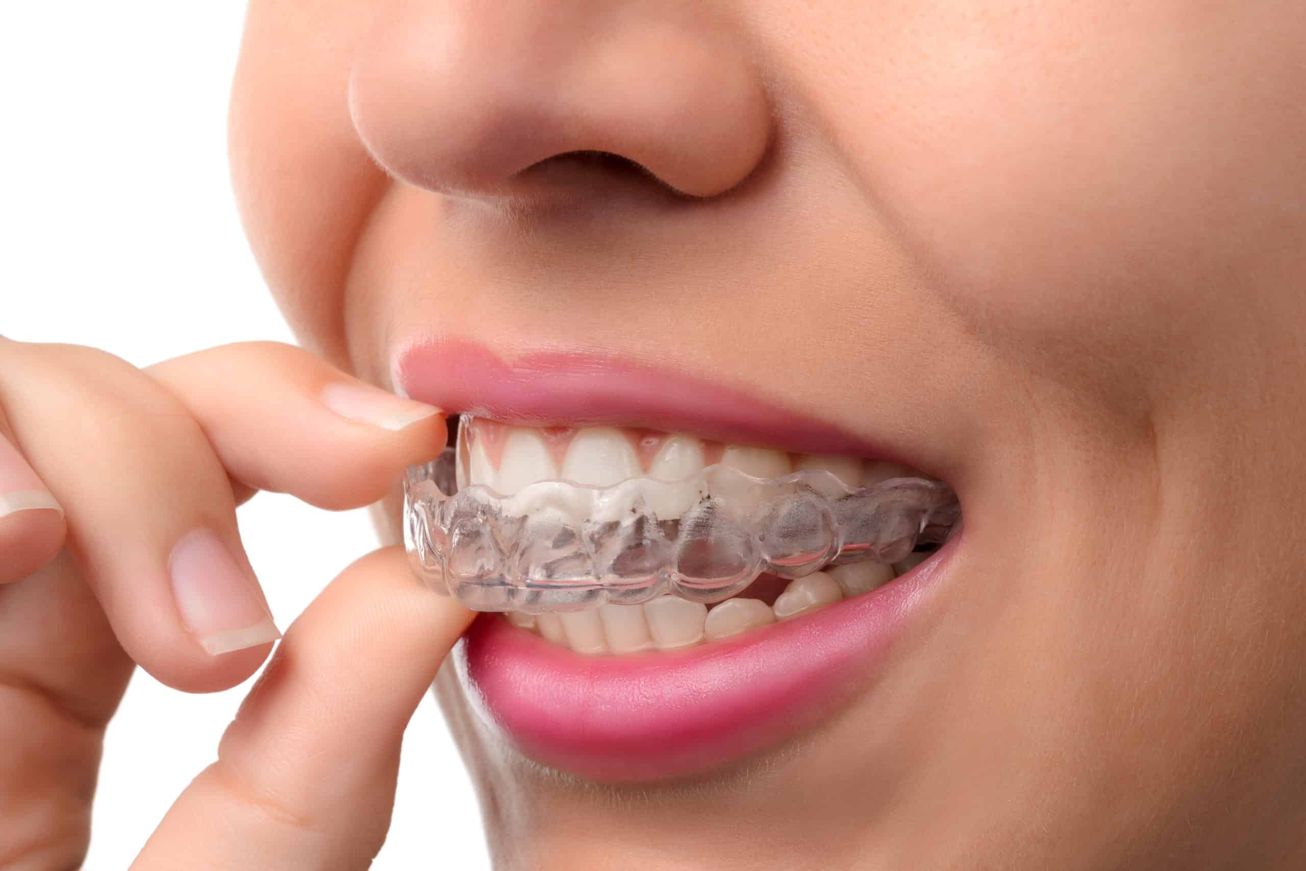 invisalign as an adult Bailey Orthodontics invisalign clear aligners Bountiful UT