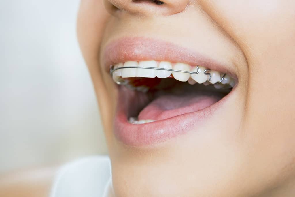 What To Do If Your Retainer Breaks Bailey Orthodontics