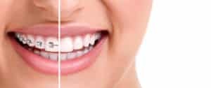 Bailey Orthodontics braces Bountiful UT