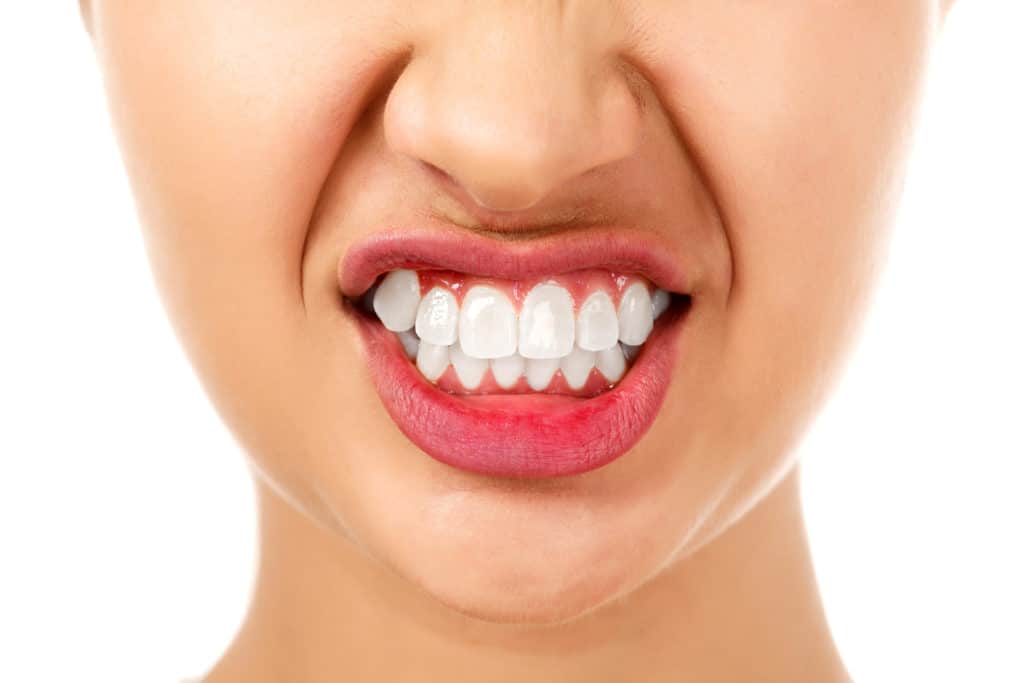 Prominent teeth due to gum recession.  