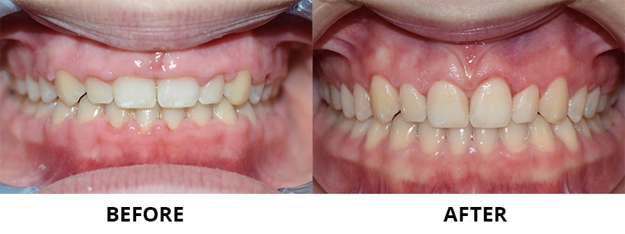 Gingival Contouring
