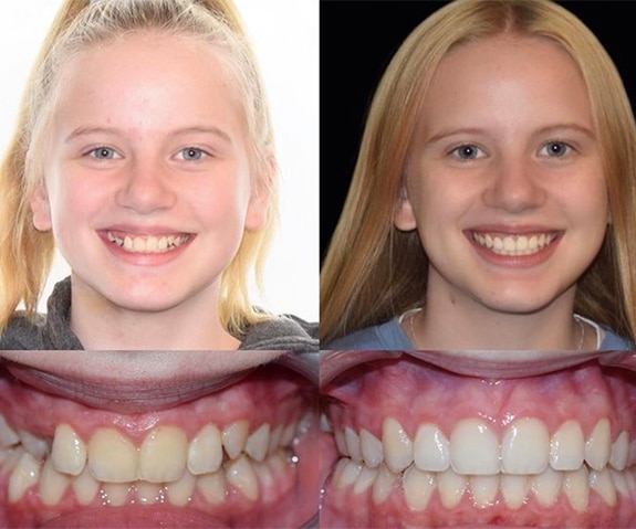 Bountiful Utah Braces