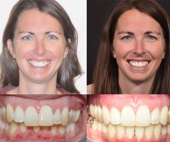 Adult Braces Bountiful Utah