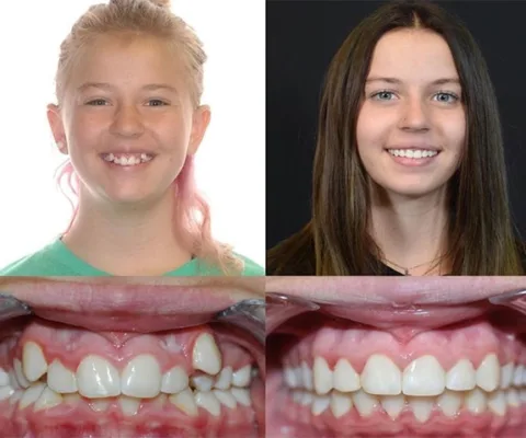 Bountiful Utah Orthodontic Treatments