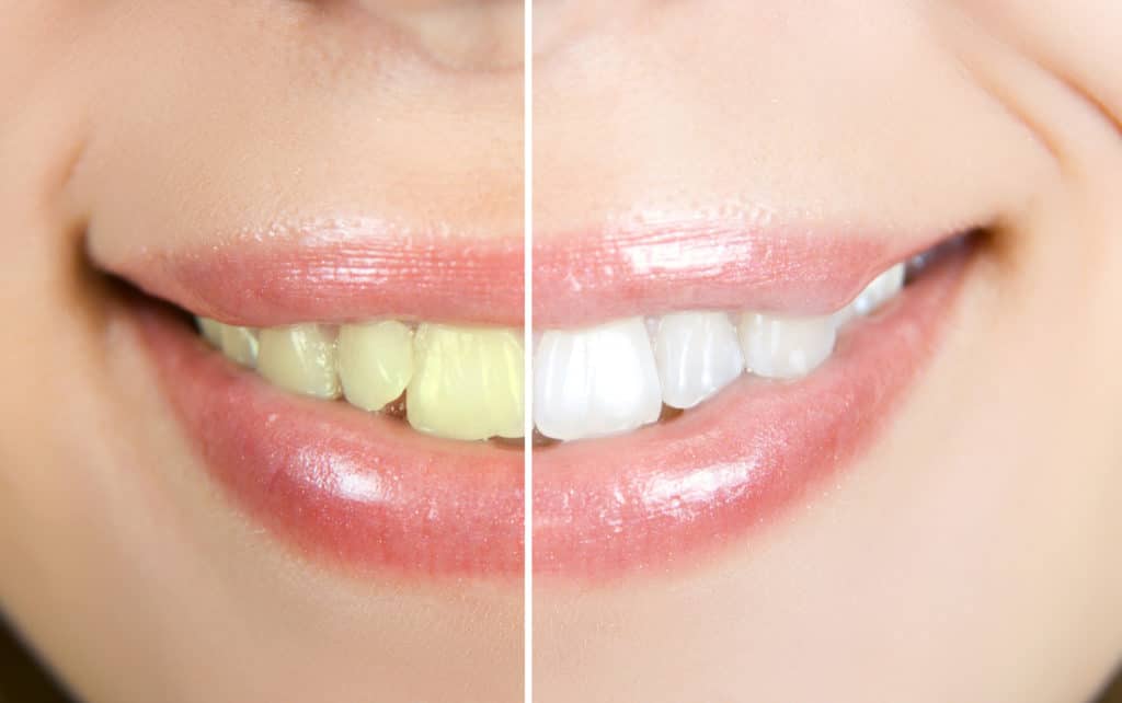 Teeth Whitening after braces Bountiful Utah 