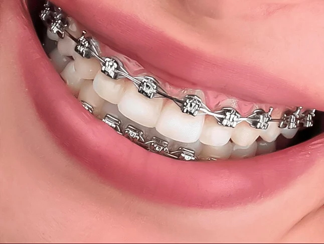 Self Ligating Brackets Bountiful Utah The dos and don'ts of braces Orthodontist