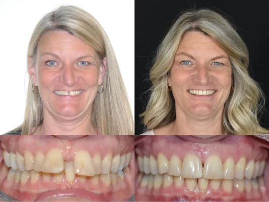 Bountiful Utah Orthodontic Treatment