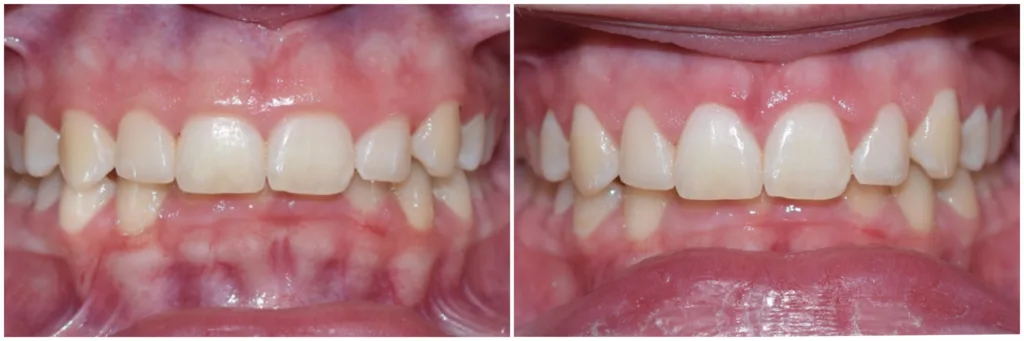 Gingival Contouring