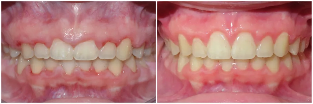Gingival Contouring
