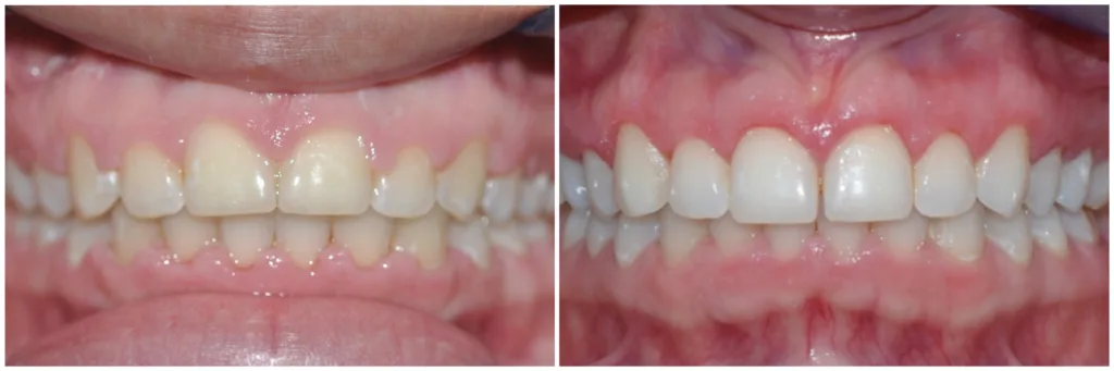 Gingival Contouring