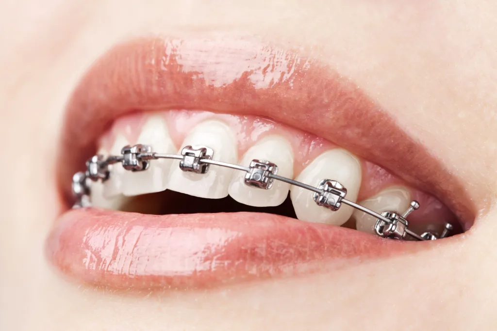 Best age for braces